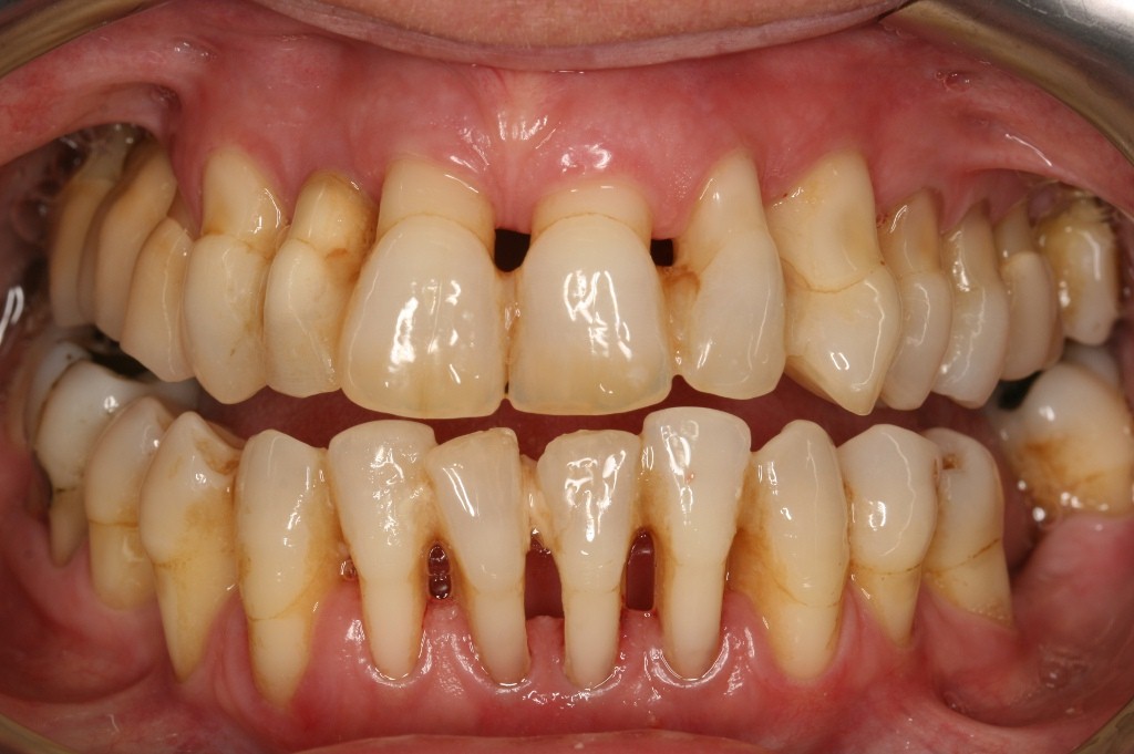 Gambar Pareidontitis